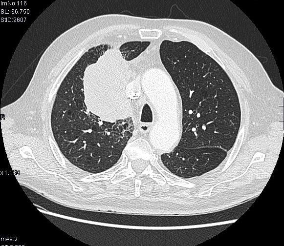 tomografia de pulmon con contraste