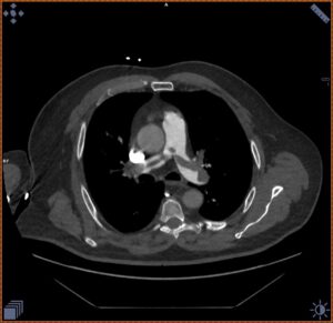 Angio-TC de arterias pulmonares (corte axial)