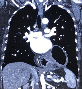 TC coronal de tórax