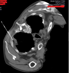 Biopsia pulmonar guiada por TC