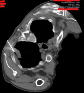 Biopsia pulmonar guiada por TC