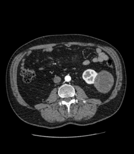 TC abdominal en 2 fases: arterial y venosa