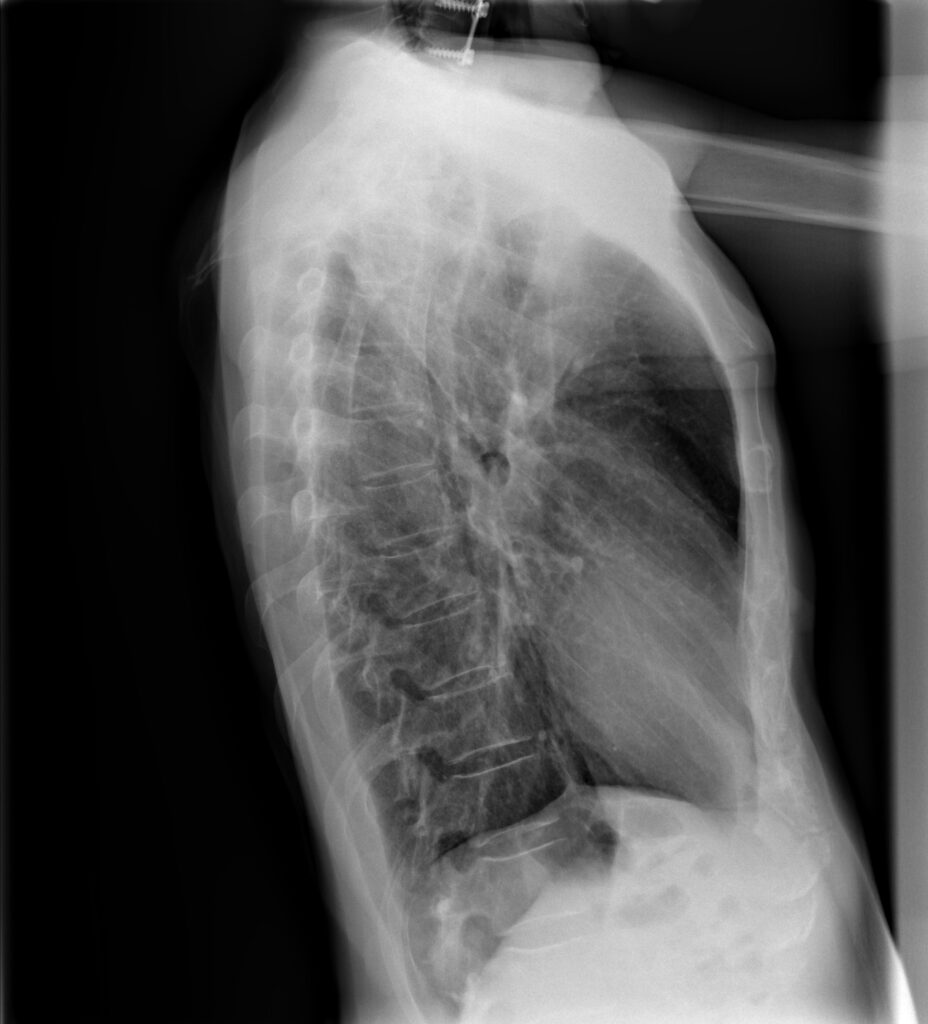 Radiografia Lateral De Torax 0118