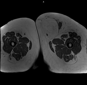 Corte axial muslo, T1 sin contraste