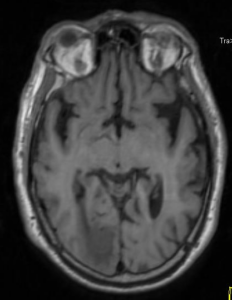 T1 axial sin contraste