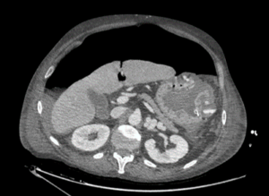 TAC toraco-abdominal