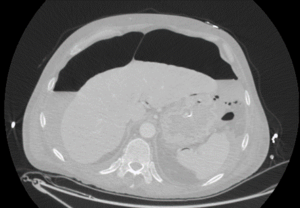 TAC toraco-abdominal