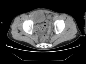 TC abdomen (ventana partes blandas)