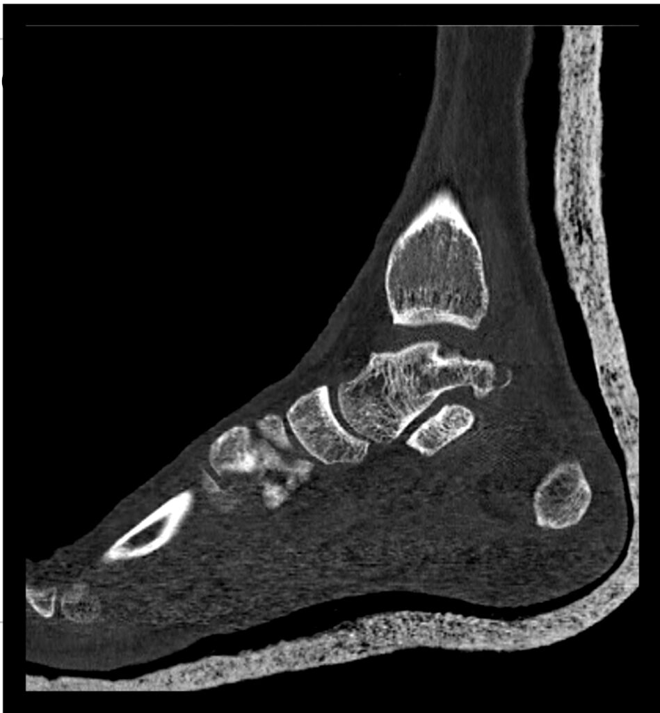 Fractura- avulsión del tubérculo medial del astrágalo