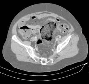 Corte transversal de TAC abdominopélvico