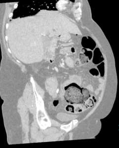 Corte parasagital de TAC abdominopélvico