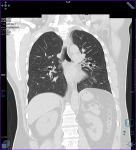 TC ventana pulmonar a los 8 años