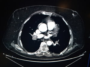 TC de arterias pulmonares 