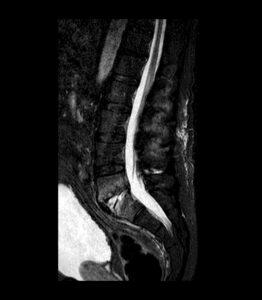 RMN SUPRESIÓN GRASA Y GADOLINIO IV T2