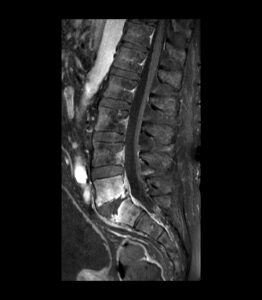 RMN SUPRESIÓN GRASA Y GADOLINIO IV T1