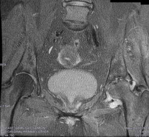 RM pélvica T2 supresión grasa