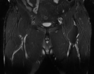 t2-Supresión grasa coronal