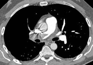 angio TC arterias pulmonares