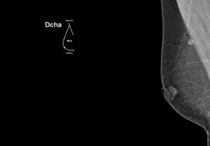 mamografia O/L derecha