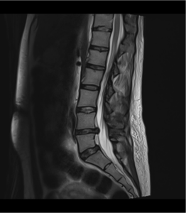 Imagen 2 R.M. lumbar sagital T2