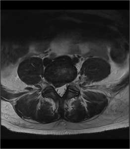 R.M. lumbar transversal T2