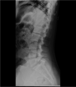 Imagen 1 Radiografía Lumbar