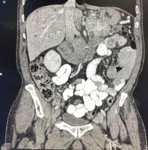 TC coronal de abdomen