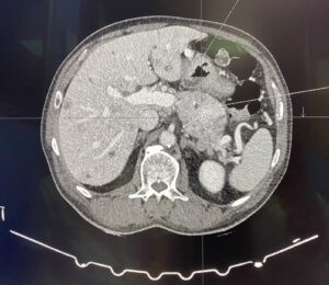 TC axial de abdomen