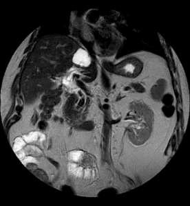 Corte Coronal RM T2 normal