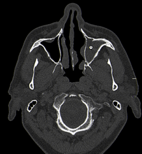 TC craneal coronal