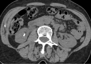 Corte axial TC simple de abdomen