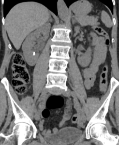 Corte coronal TC simple de abdomen