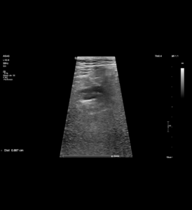 Engrosamiento parietal colon