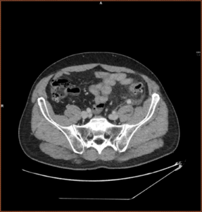 TC abdomen (corte axial, fase portal)