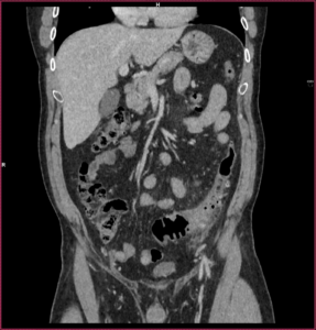 TC abdomen (reconstrucción coronal, fase venosa)