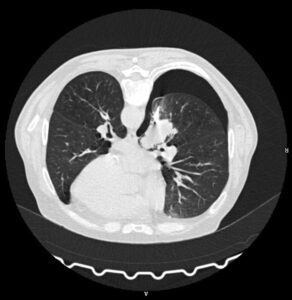 TC de tórax después de complicación realizada en intervención de biopsia 