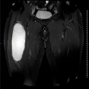 T2 supresión grasa coronal