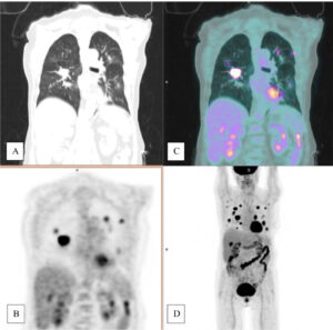 PET/TC con inyección de 18F-FDG. (A) Corte coronal de TC toracoabdominal (ventana pulmonar), (B) PETC y (C) PET/TC. (D) Proyección de máxima intensidad (MIP) de estudio PET-FDG.