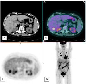 PET/TC con inyección de 18F-FDG. (A) Corte axial de TC de abdomen, (B) PET y (C) PET/TC. (D) Proyección de máxima intensidad (MIP) de estudio PET-FDG.