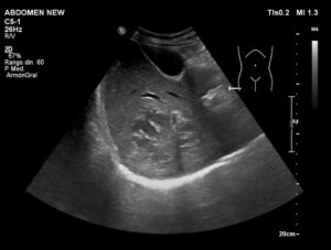 ECOGRAFÍA ABDOMINAL