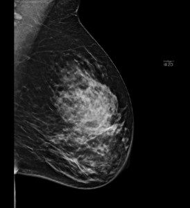 Mamografía oblicua o medio-lateral