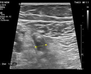 Ecografía abdominal