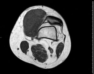 RM en T1 de rodilla derecha