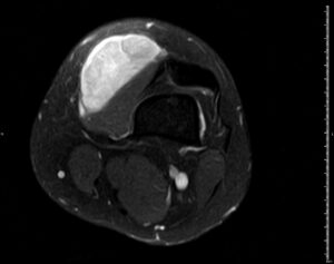 RM T2 + supresión de grasa rodilla derecha