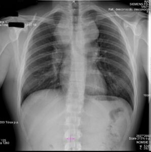 Radiografía de tórax PA